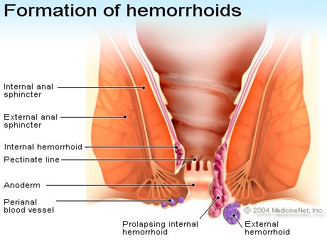 Picture of the formation of hemorrhoids