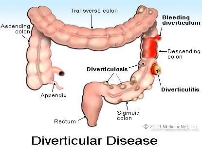 Picture of diverticular disease (diverticulitis)