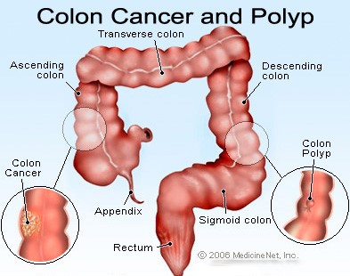 Picture of the colon with colon cancer and colon polyps